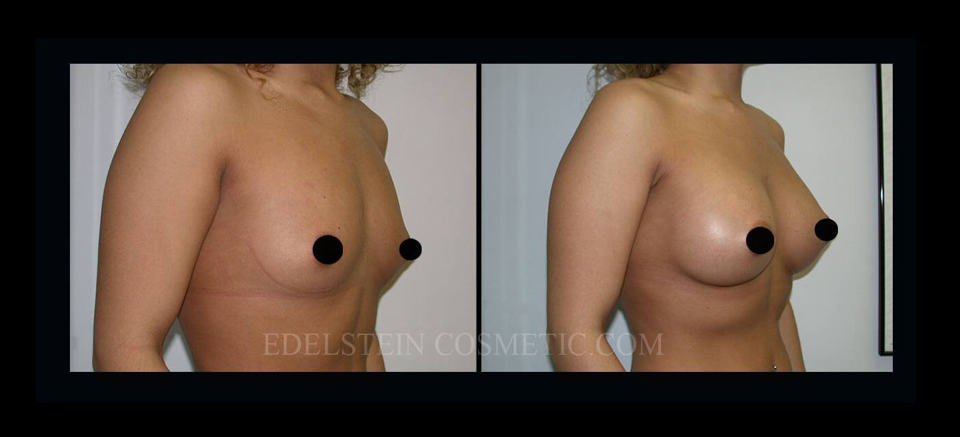 Breast Augmentation case #26846