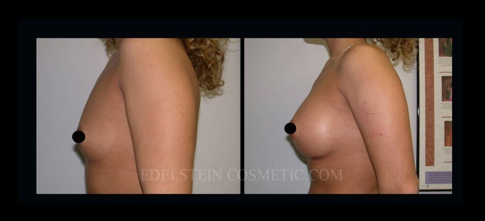 Breast Augmentation case #26846