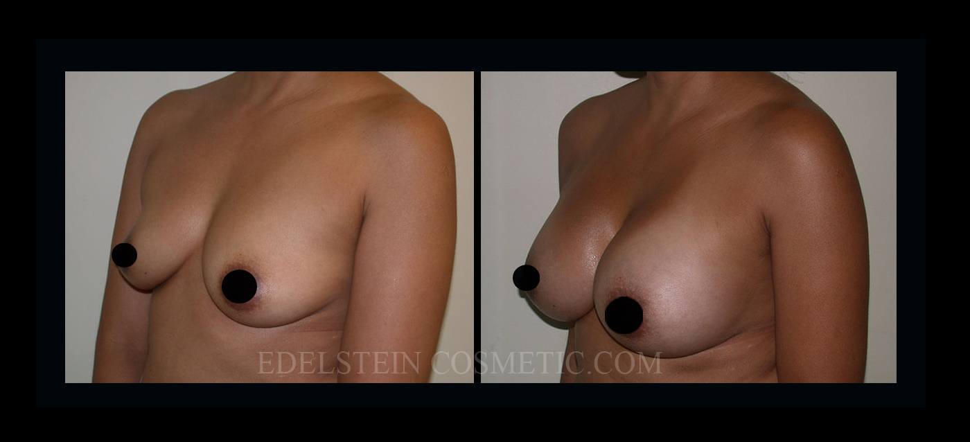 Breast Augmentation case #26845