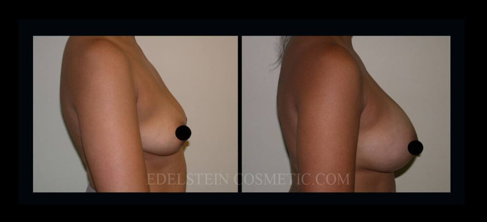 Breast Augmentation case #26845