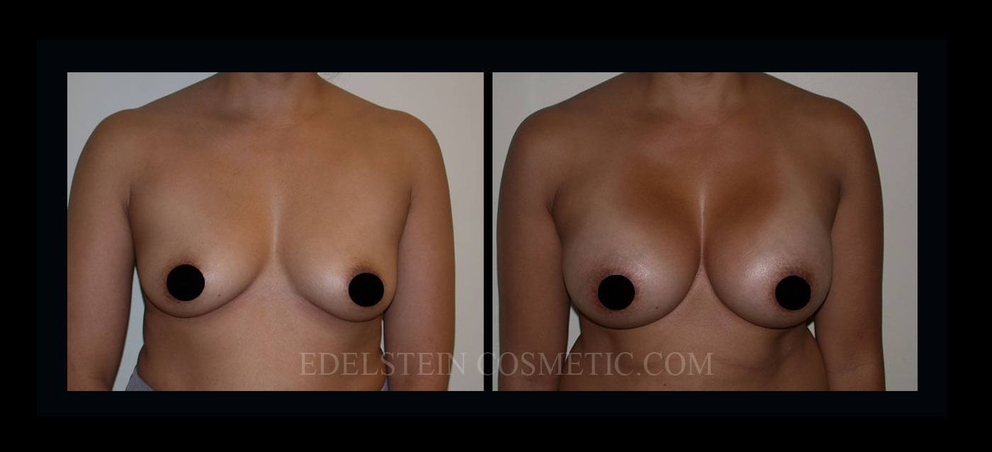 Breast Augmentation case #26845