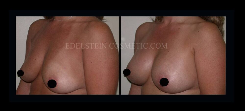 Breast Augmentation case #26844