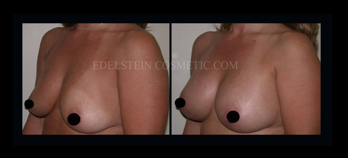 Breast Augmentation case #26844