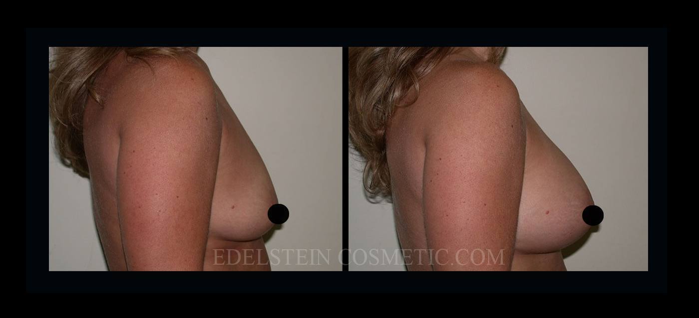 Breast Augmentation case #26844