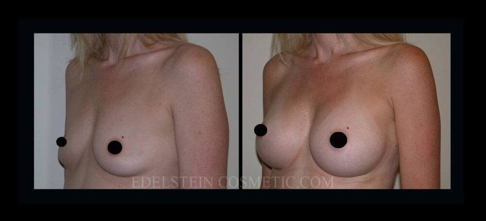 Breast Augmentation case #26843