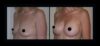 Breast Augmentation case #26843 slider thumbnail