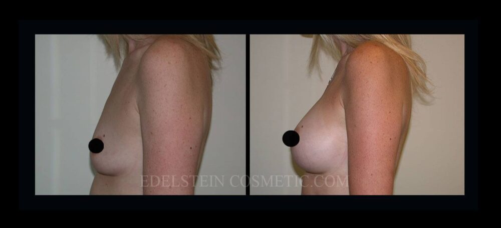 Breast Augmentation case #26843