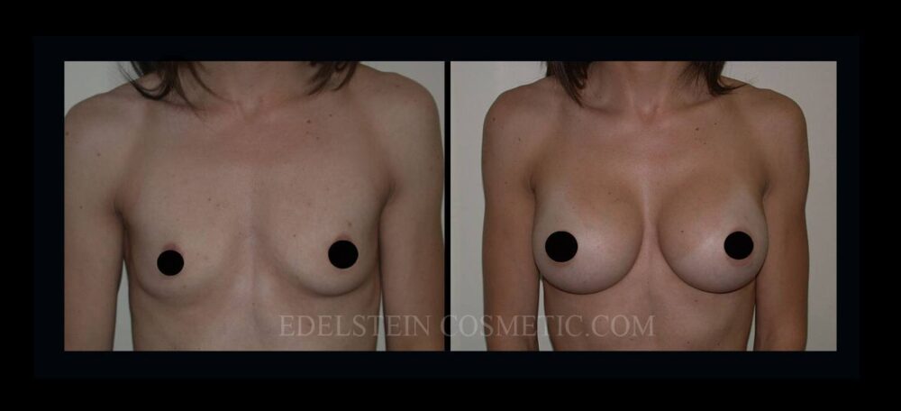 Breast Augmentation case #26842