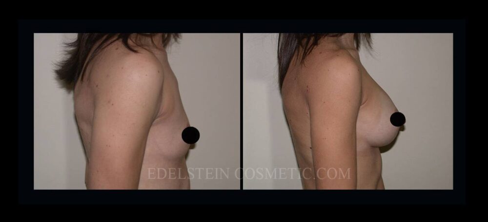 Breast Augmentation case #26842