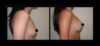 Breast Augmentation case #26840 slider thumbnail