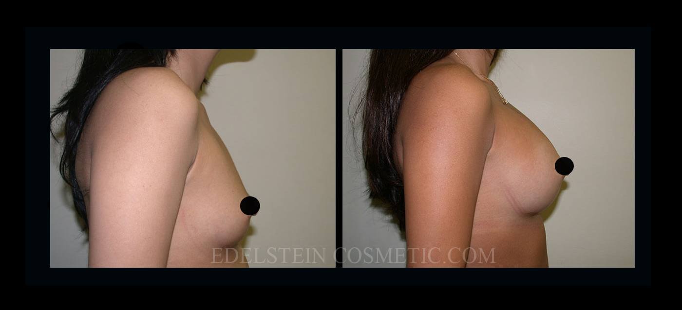 Breast Augmentation case #26840