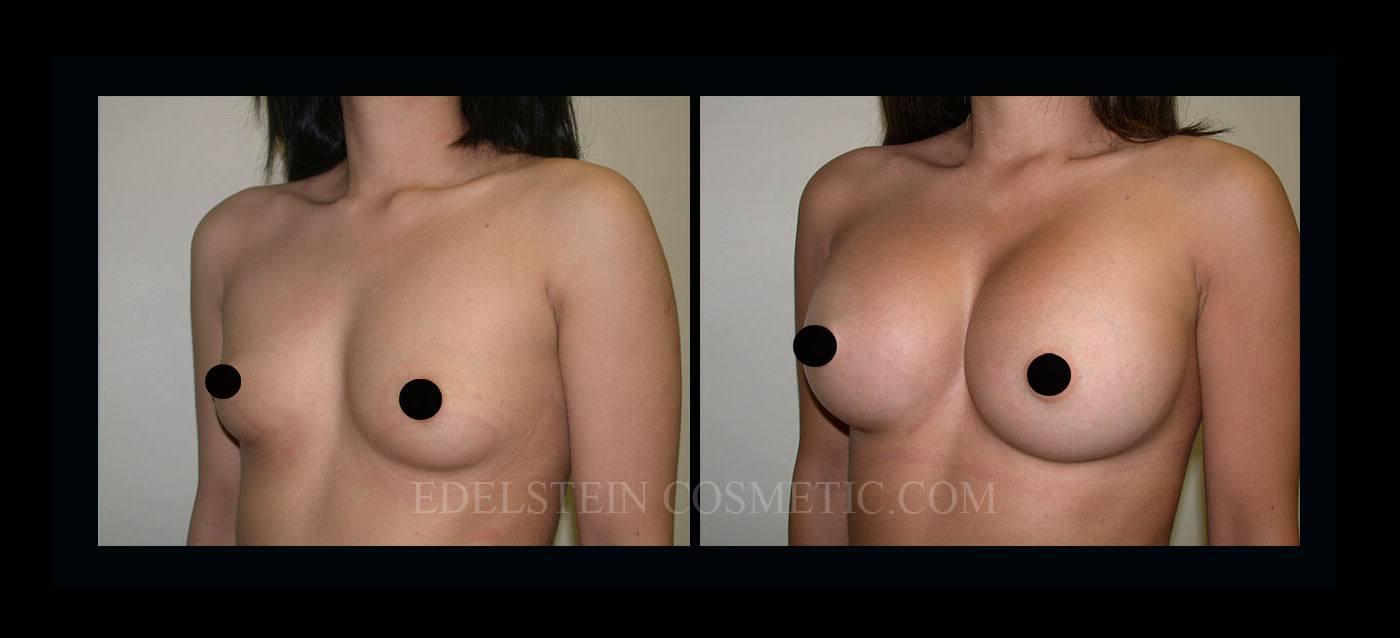 Breast Augmentation case #26840