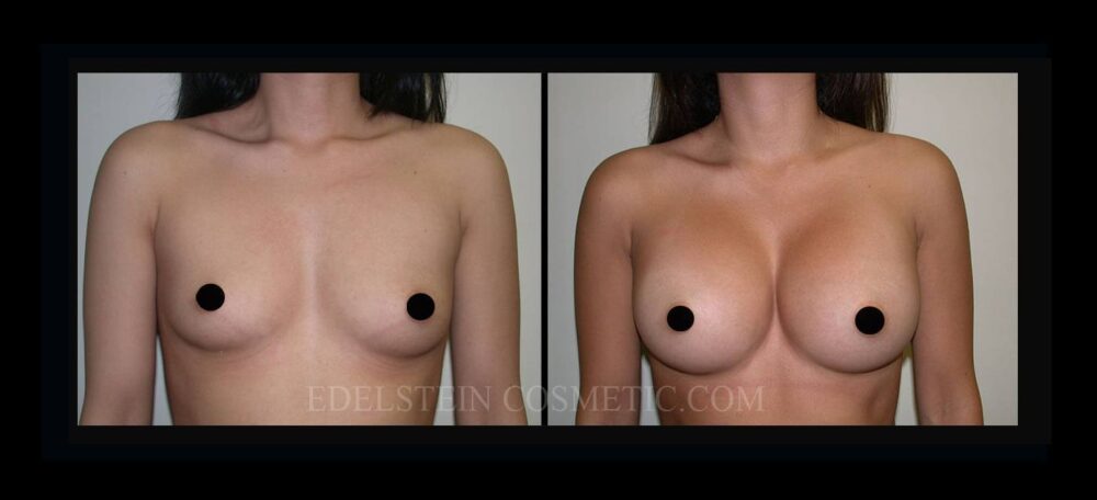 Breast Augmentation case #26840