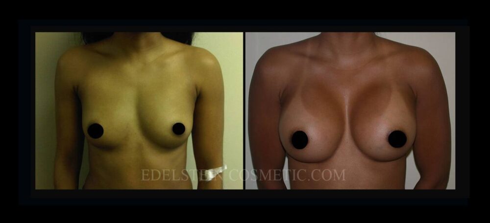 Breast Augmentation case #26838