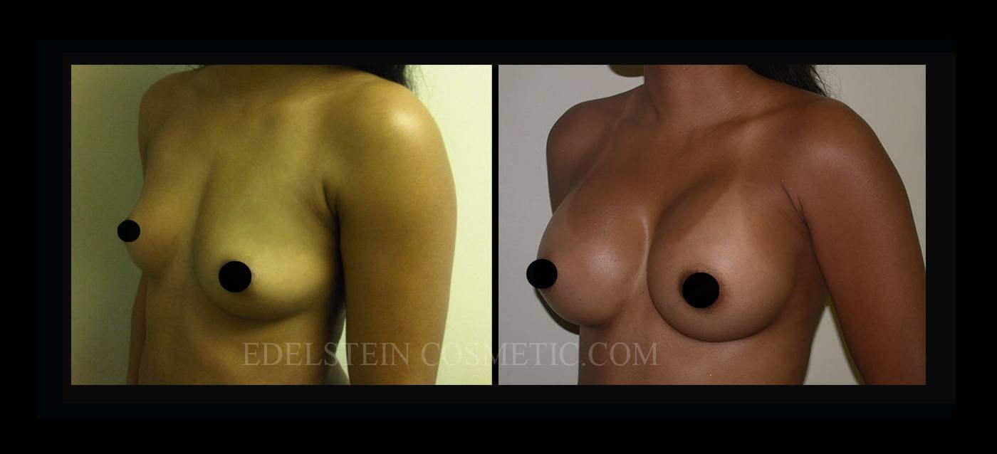 Breast Augmentation case #26838