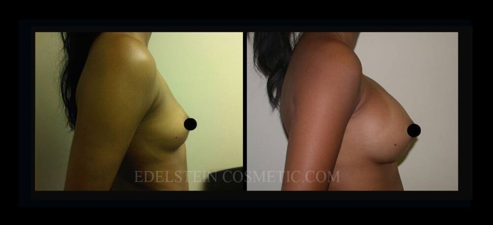 Breast Augmentation case #26838