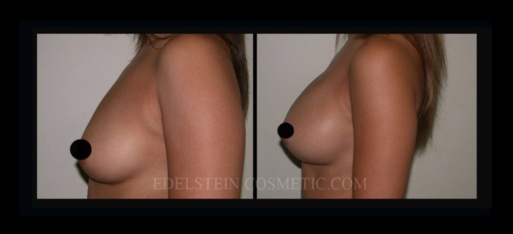 Breast Augmentation case #26837