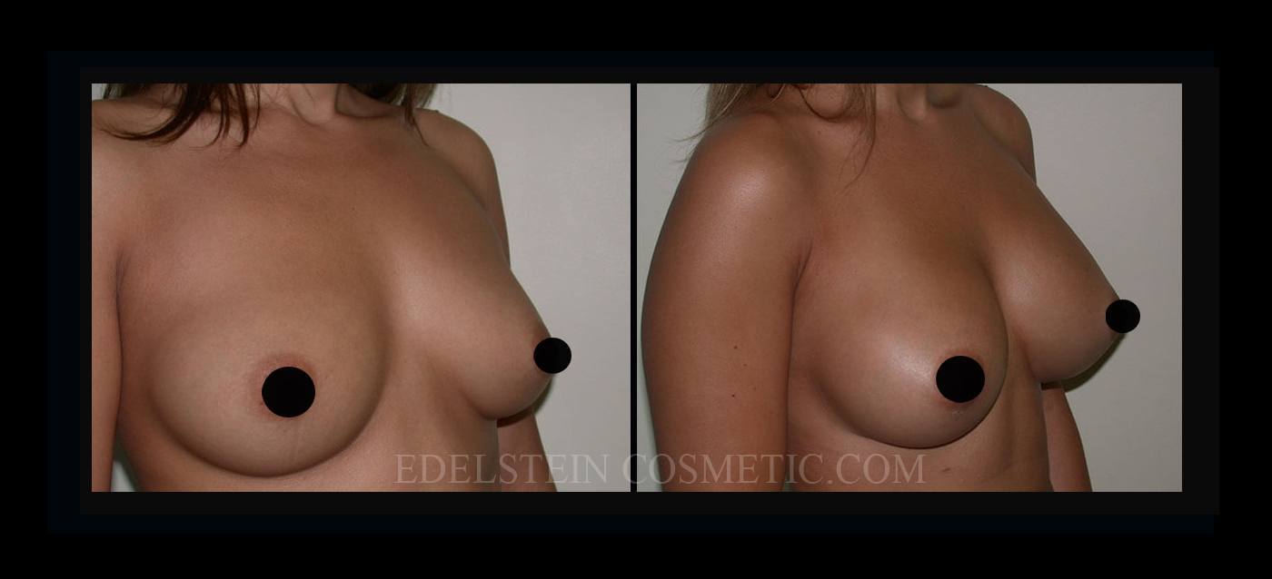 Breast Augmentation case #26837