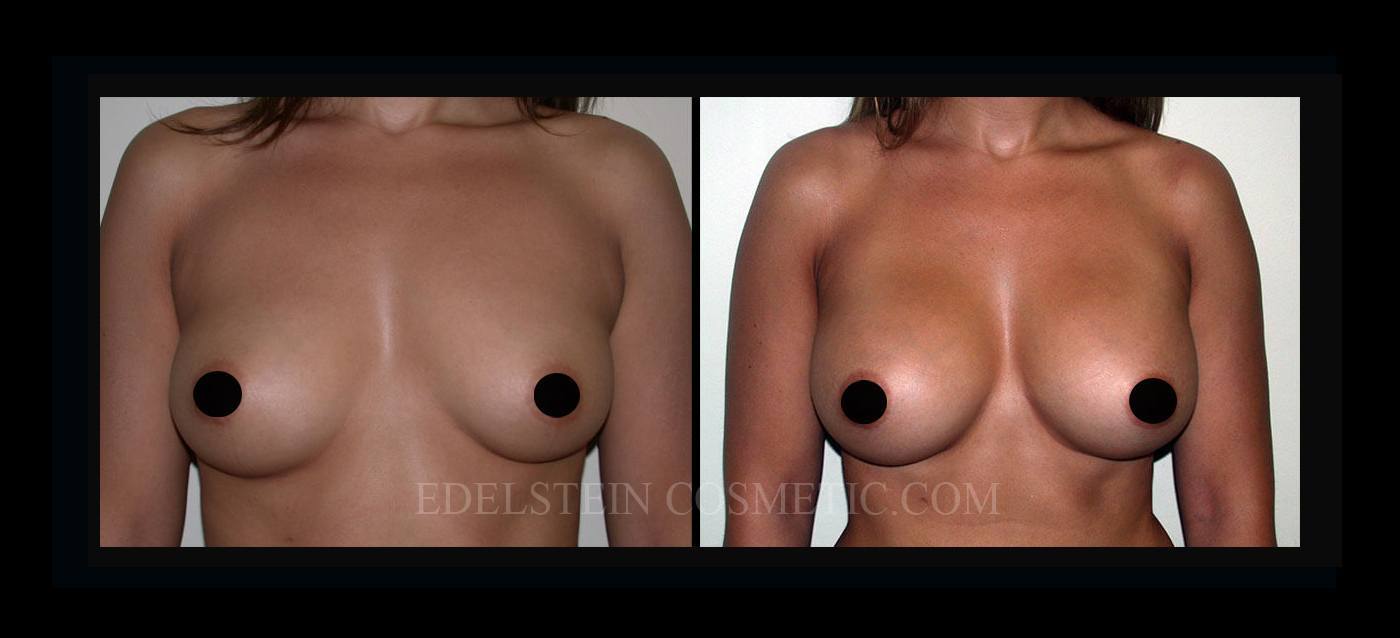 Breast Augmentation case #26837