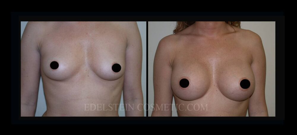 Breast Augmentation case #26834