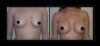 Breast Augmentation case #26834 slider thumbnail