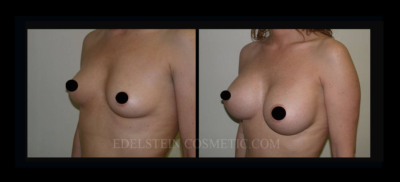 Breast Augmentation case #26834