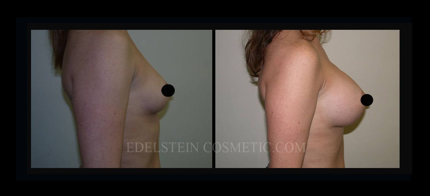 Breast Augmentation case #26834