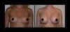 Breast Augmentation case #26830 slider thumbnail