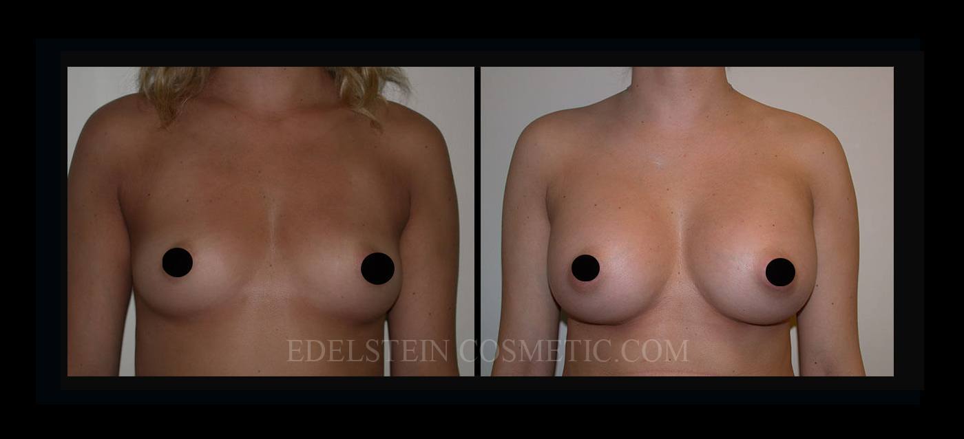 Breast Augmentation case #26830