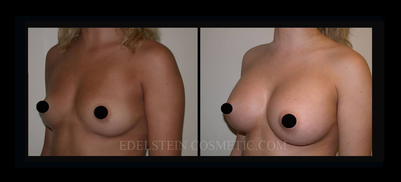 Breast Augmentation case #26830