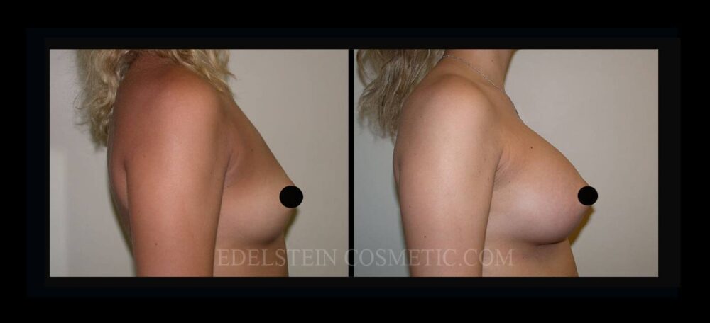 Breast Augmentation case #26830