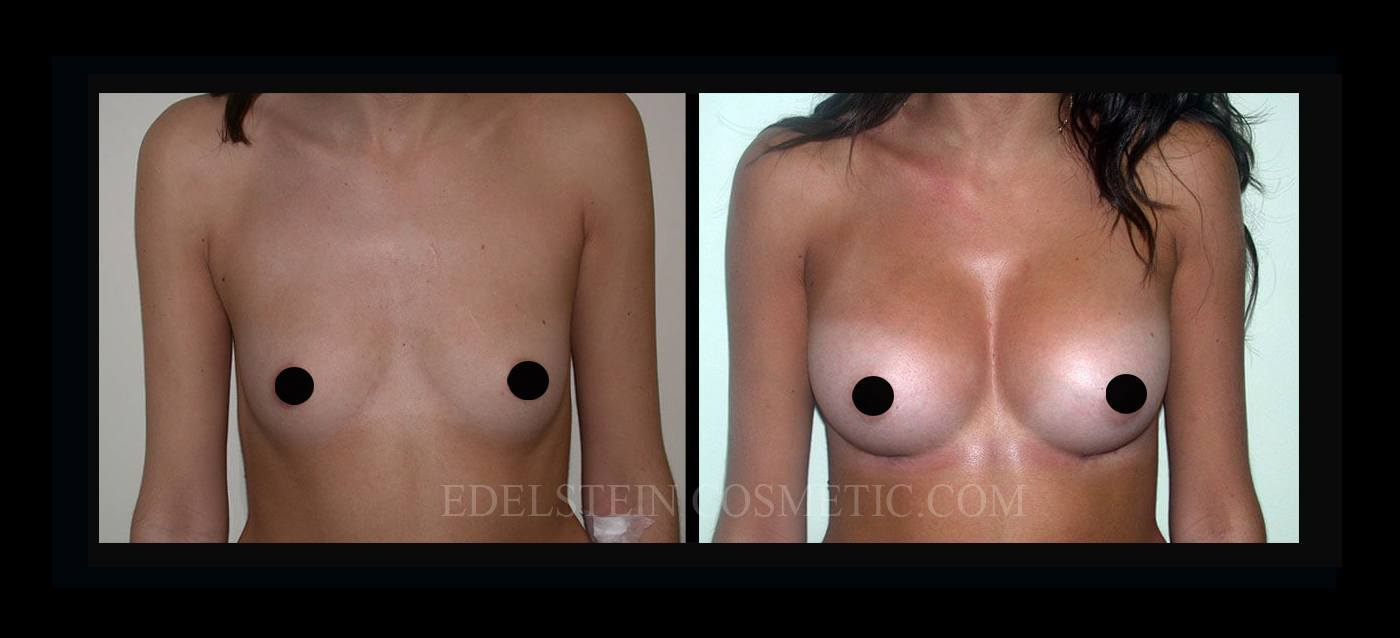 Breast Augmentation case #26833