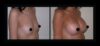 Breast Augmentation case #26833 slider thumbnail