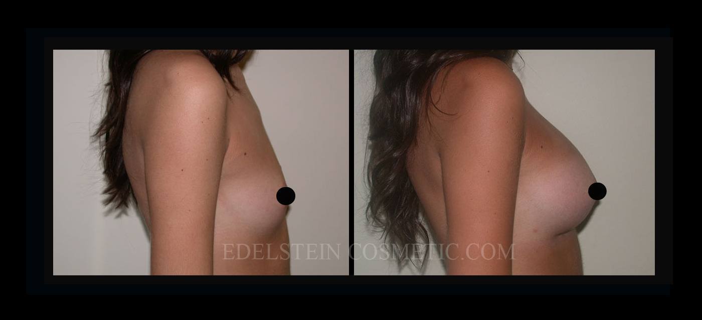 Breast Augmentation case #26833