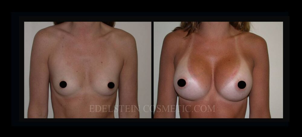 Breast Augmentation case #26826