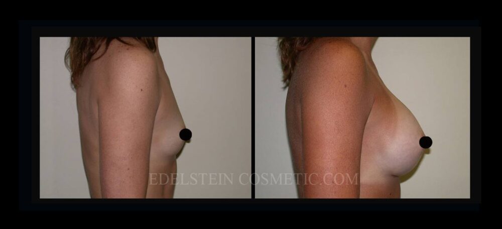 Breast Augmentation case #26826