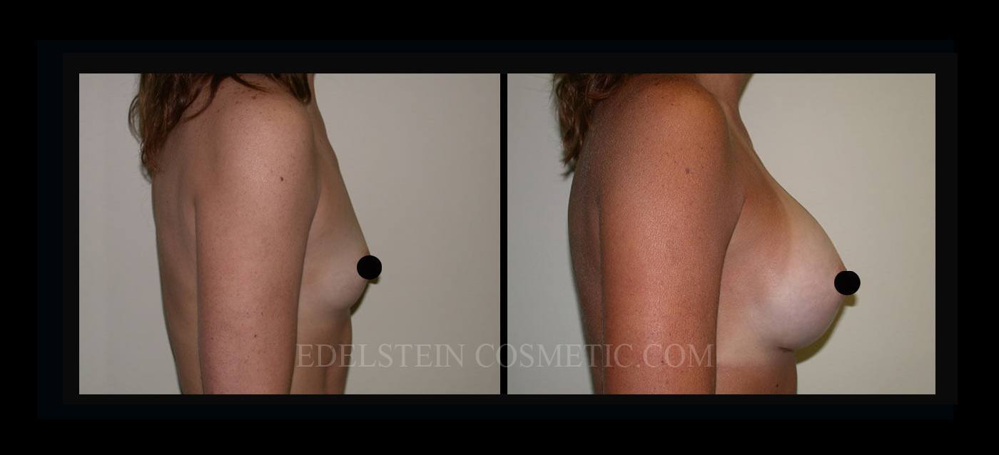 Breast Augmentation case #26826