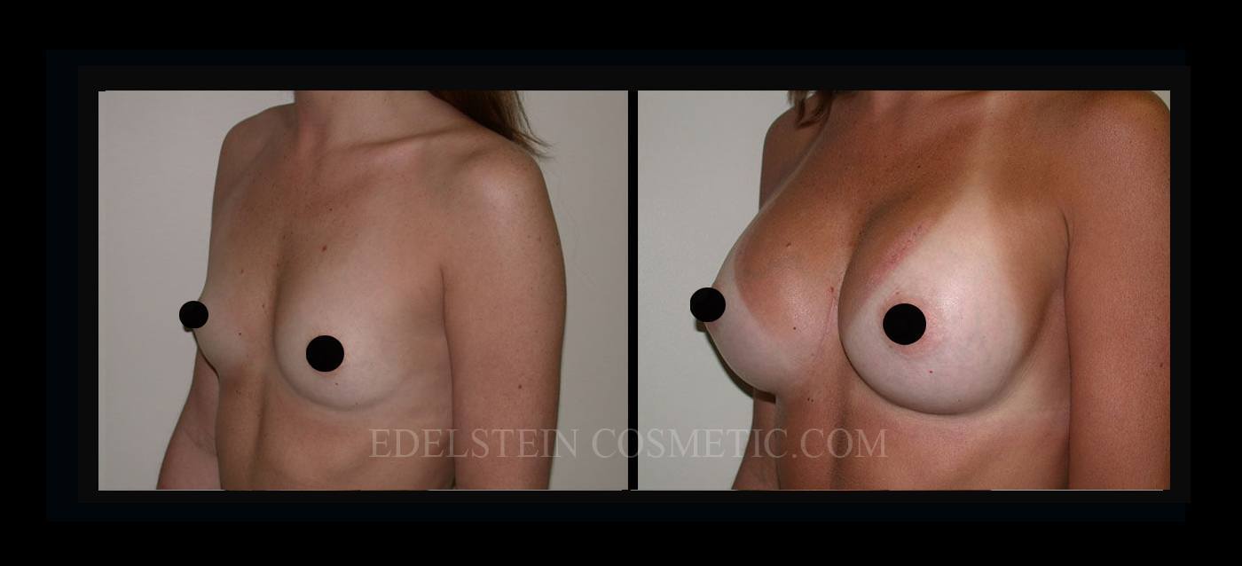 Breast Augmentation case #26826