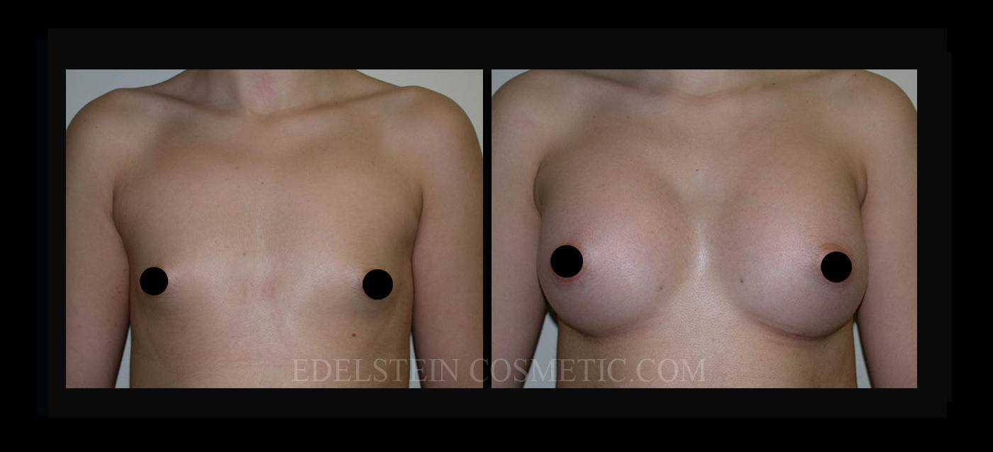 Breast Augmentation case #26825