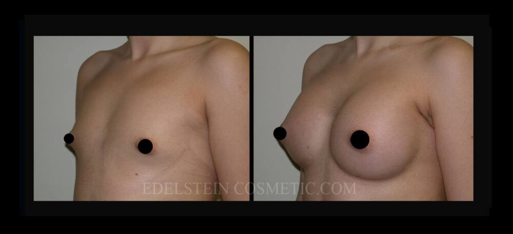 Breast Augmentation case #26821