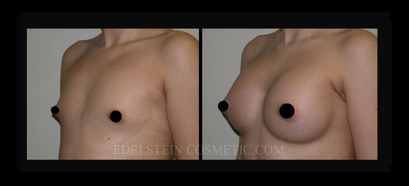 Breast Augmentation case #26825
