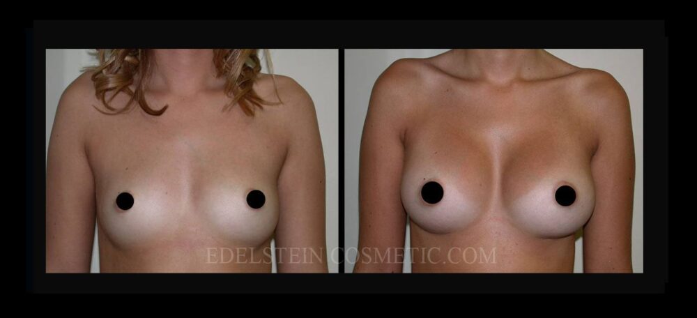 Breast Augmentation case #26821