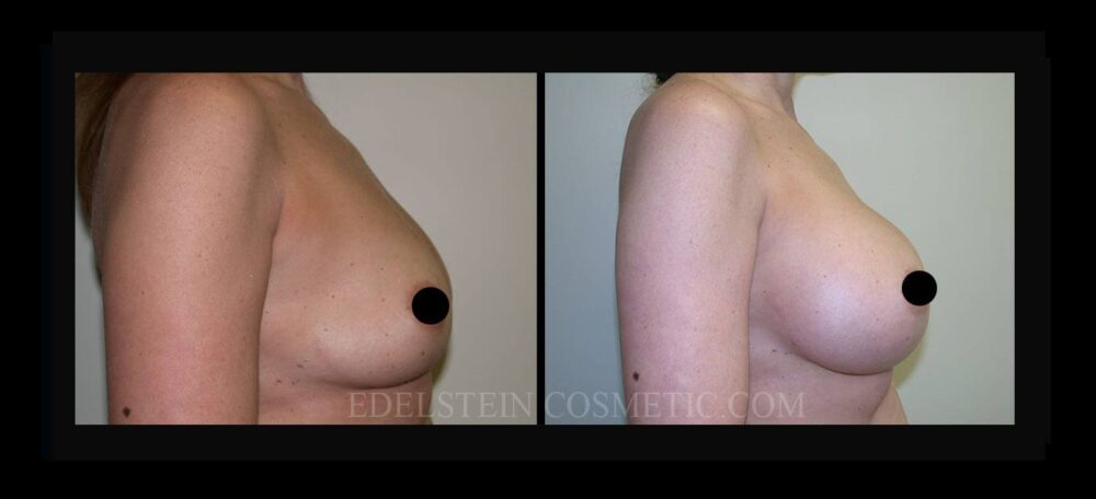 Breast Augmentation case #26820