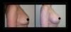 Breast Augmentation case #26820 slider thumbnail