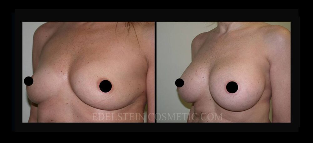 Breast Augmentation case #26820