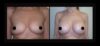 Breast Augmentation case #26820 slider thumbnail