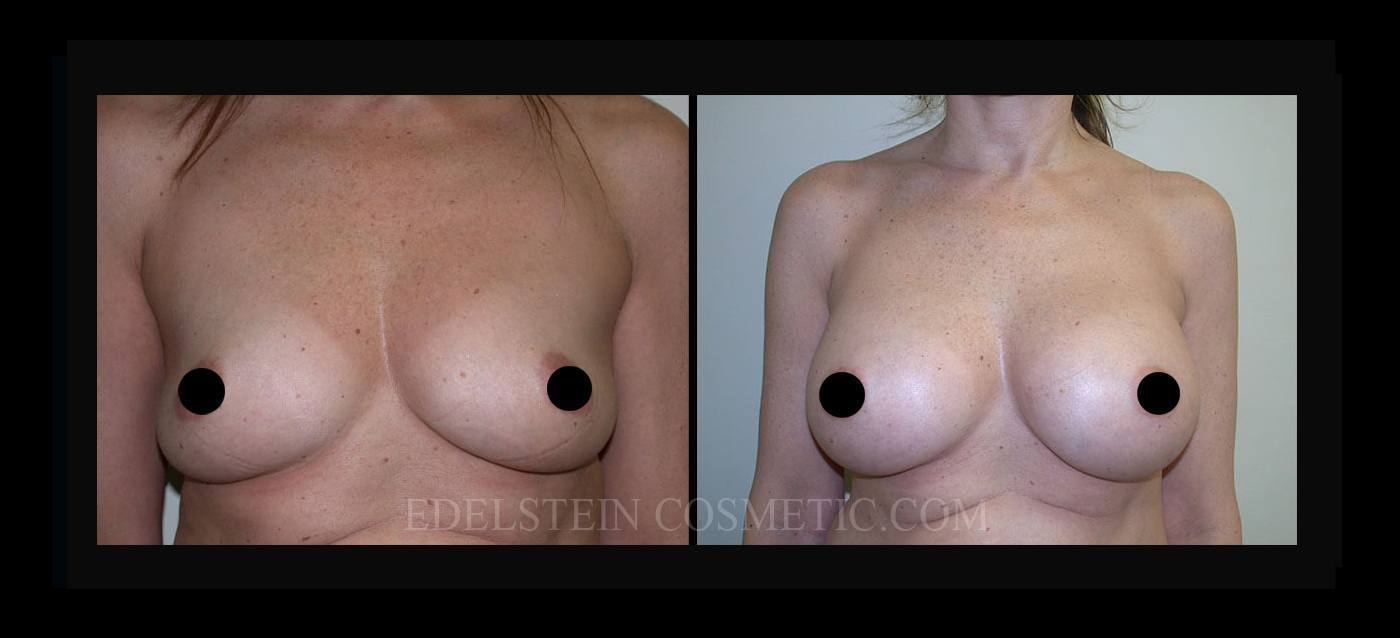 Breast Augmentation case #26820
