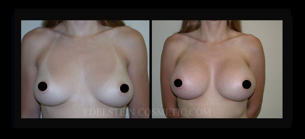 Breast Augmentation case #26817