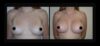 Breast Augmentation case #26817 slider thumbnail