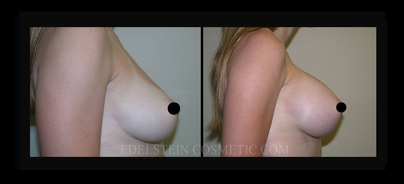 Breast Augmentation case #26817